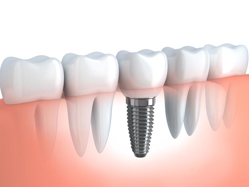 Dental Implants Richmond, TX 