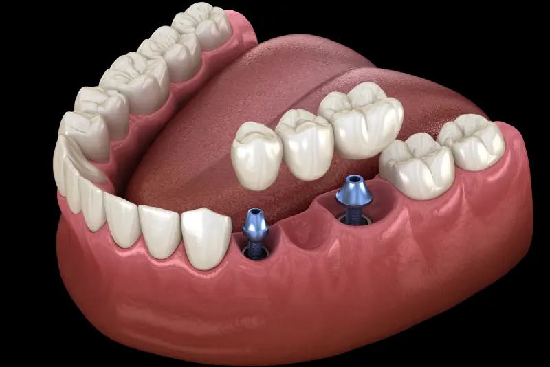 Dental Implants