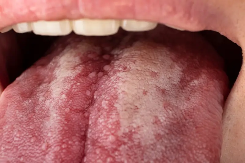 Oral Cancer Screenings